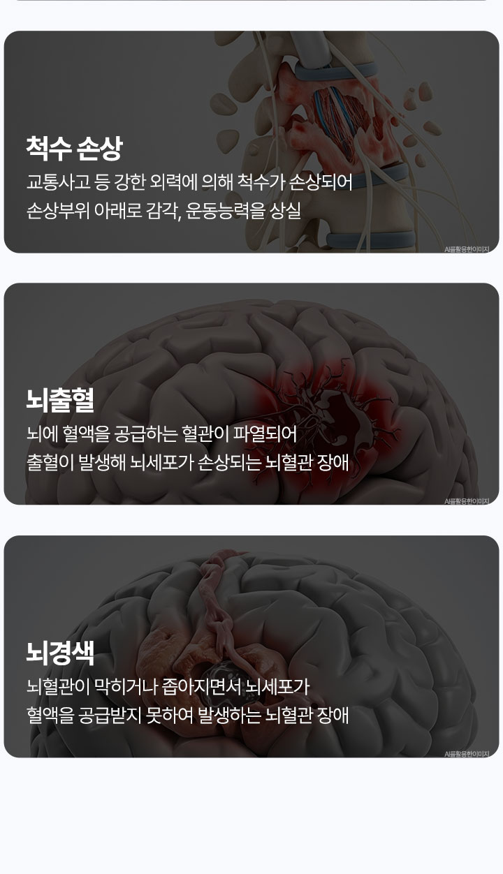 척수 손상, 뇌출혈, 뇌경색